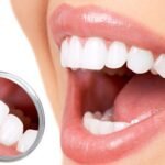 الفيلر للاسنان