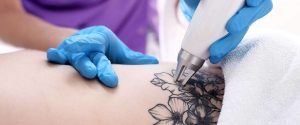 كيفية إزالة الوشم كورس التجميل والليزر