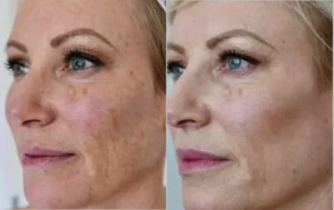 كورس نانو فات للأطباء